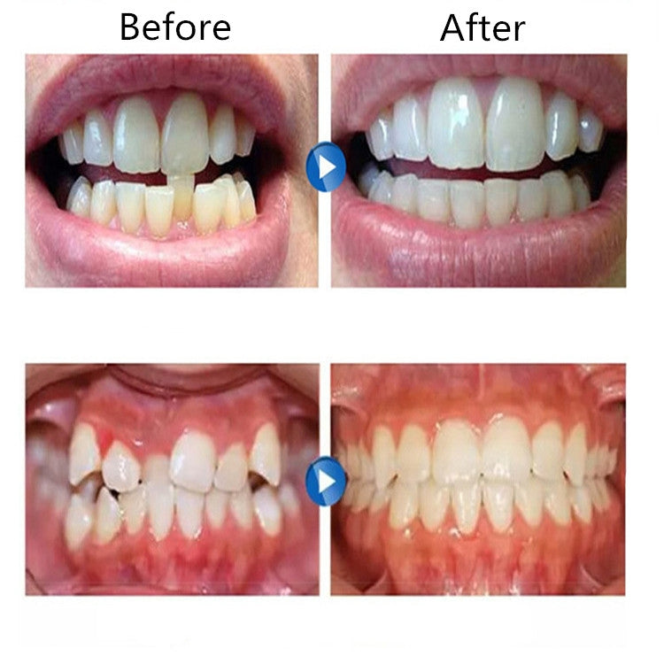 Orthodontic Appliance Silicone Simulation Braces Anti-molar Braces for Night(The second stage) - Dental Tools by PMC TechLife | Online Shopping South Africa | PMC TechLife